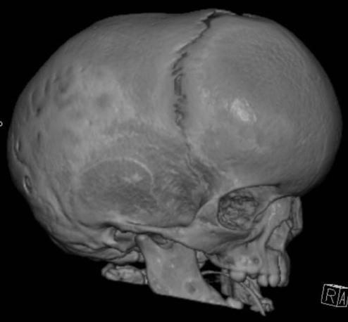 sutures of cranium. of the cranial sutures.